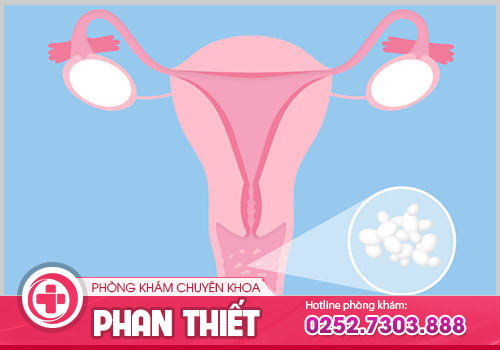 Bệnh khí hư là gì và cách chữa ra sao?