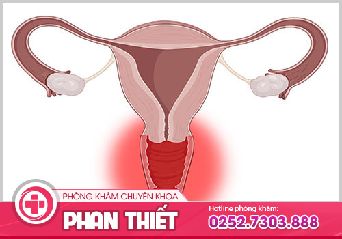 Bệnh viêm âm đạo cấp là gì và có nguy hiểm hay không?