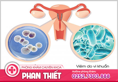 Bệnh viêm âm đạo cấp tính và những thông tin cần biết?