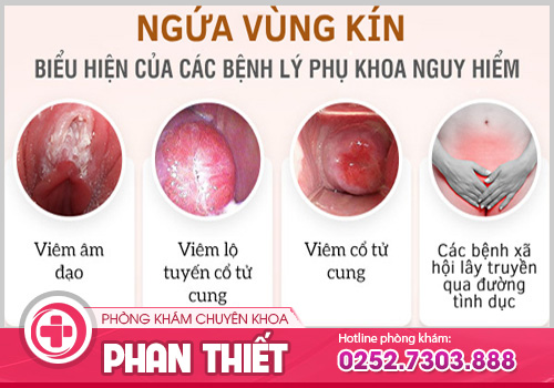 Bị ngứa âm đạo phải làm sao?