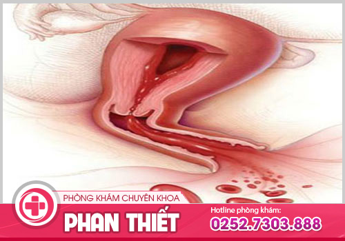 Âm đạo ra máu đen cảnh báo các bệnh viêm nhiễm phụ khoa nguy hiểm