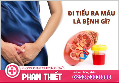 Đi tiểu ra máu là bệnh gì? Nguy Hiểm Chớ Xem Nhẹ