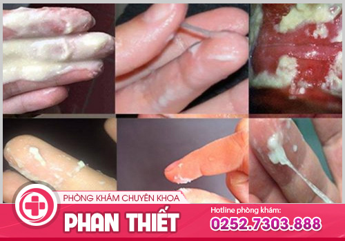 Chia sẻ hình ảnh ngứa vùng kín để nhận biết và điều trị