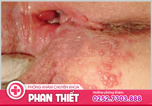 Chia sẻ hình ảnh ngứa vùng kín để nhận biết và điều trị