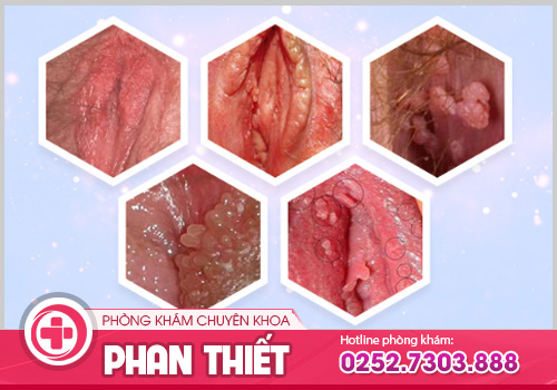 Chia sẻ hình ảnh ngứa vùng kín để nhận biết và điều trị