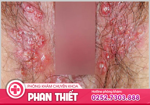 Chia sẻ hình ảnh ngứa vùng kín để nhận biết và điều trị