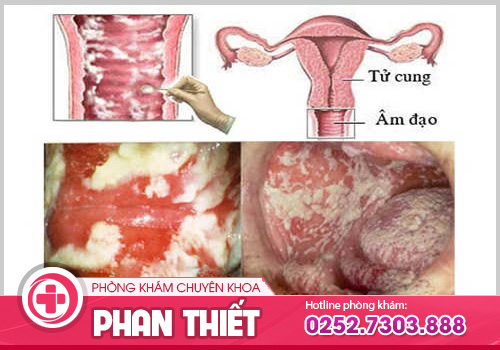 Chia sẻ hình ảnh ngứa vùng kín để nhận biết và điều trị