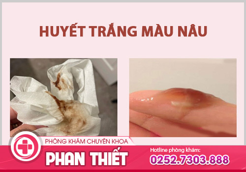 Huyết trắng màu nâu - Triệu chứng nguy hiểm khó lường