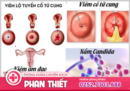 Khí hư màu hồng: Bình thường hay cảnh báo bệnh phụ khoa?