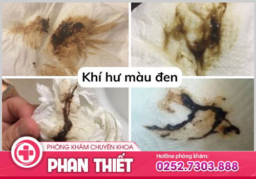 Khí hư màu đen có đáng lo ngại không? Điều trị như thế nào?