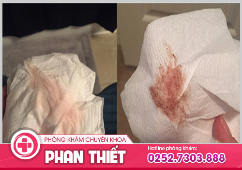 Khí hư màu hồng: Bình thường hay cảnh báo bệnh phụ khoa?