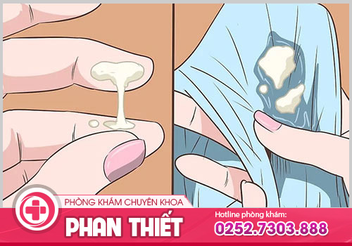 huyết trắng vón cục