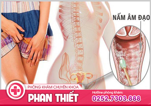 Nấm âm đạo và những thông tin cần biết