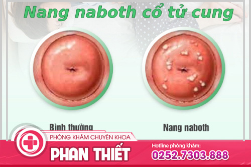 Nang Naboth Cổ Tử Cung: Nguyên Nhân, Dấu Hiệu Và Cách Trị