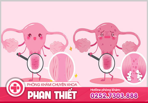 Nguyên nhân gây bệnh viêm âm đạo ở nữ giới hết sức quan tâm?