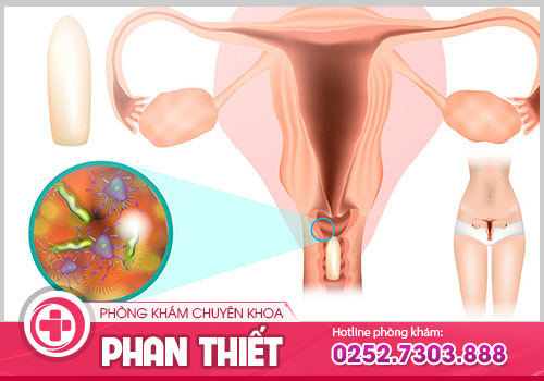 Nguyên nhân viêm âm đạo là gì? Cách trị bệnh?