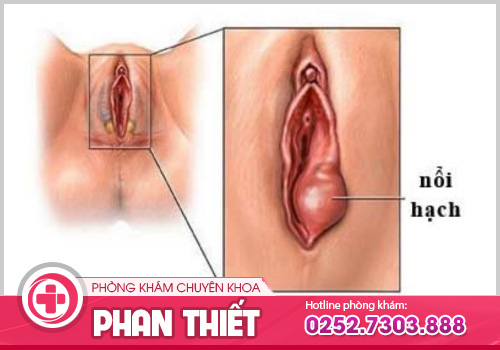 nổi hạch vùng kín