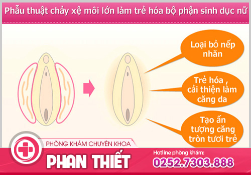 Phẫu thuật cắt môi lớn - Bí quyết giữ gìn thanh xuân cho chị em