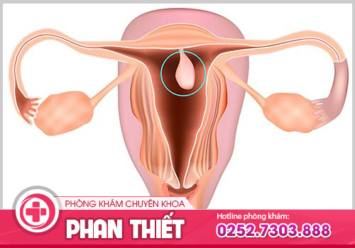 Polyp cổ tử cung là gì? Có nguy hiểm không?