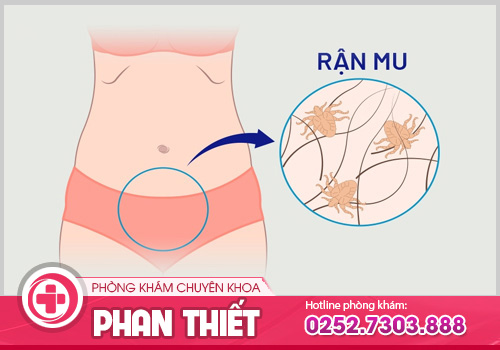 Rận mu - Bệnh nguy hiểm chớ chủ quan!