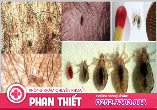 Rận mu - Bệnh nguy hiểm chớ chủ quan!