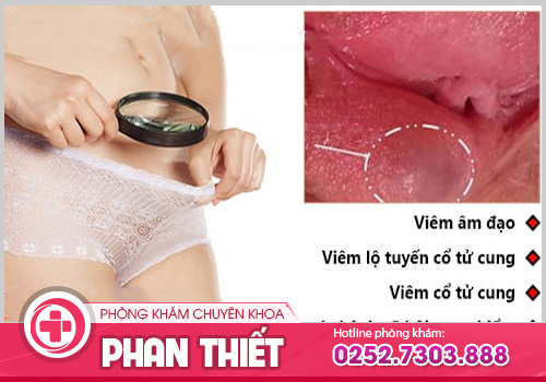 Sưng mép vùng kín - Dấu hiệu cảnh báo viêm nhiễm cơ quan sinh dục