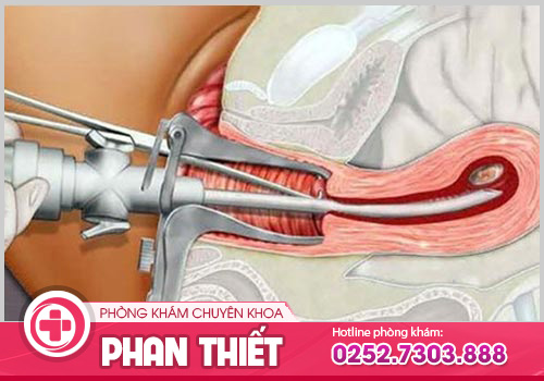 Tổng quan về bệnh viêm lộ tuyến CTC