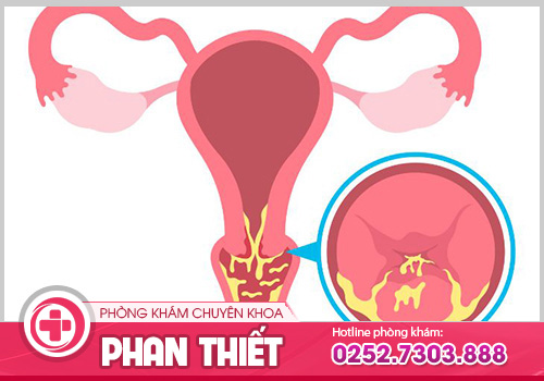 Trễ kinh ra huyết trắng vón cục có nguy hiểm không?