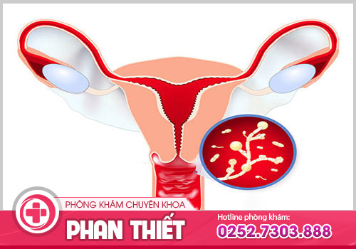 Viêm âm đạo có nguy hiểm không?