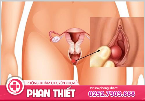 Viêm Bartholin là bệnh gì? Có nguy hiểm không?