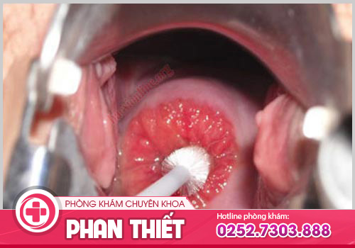 Viêm cổ tử cung có nguy hiểm không? Dấu hiệu nhận biết và cách điều trị