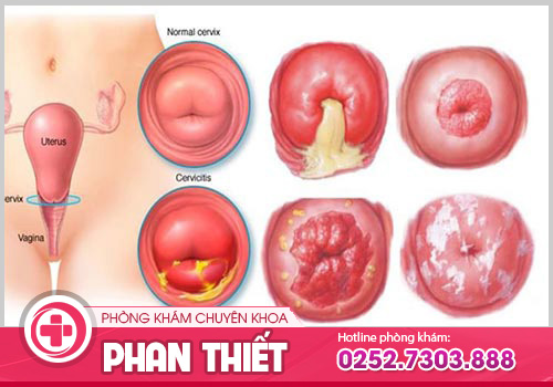 Viêm Lộ Tuyến Cổ Tử Cung Là Gì? Dấu Hiệu Và Cách Điều Trị Hiệu Quả