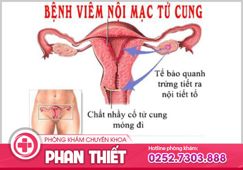 viêm nội mạc tử cung
