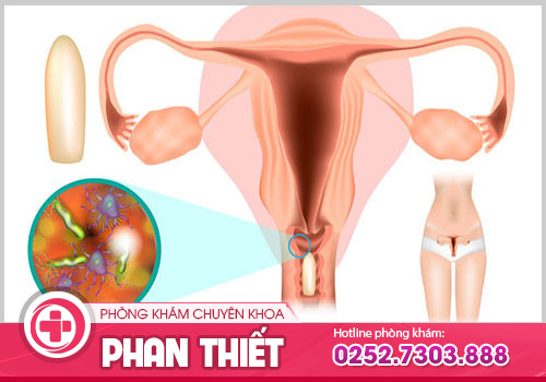 Viêm vùng kín có dấu hiệu ra sao ở nữ giới?